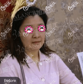 做V美減齡面部提升術前舊照 做V美減齡面部提升術前舊照