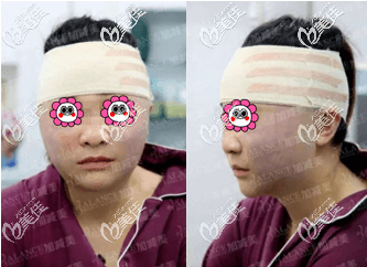 做V美減齡術后頭一日 做V美減齡術后頭一日