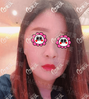 了解了V美減齡怎么做和保持時間我就做了手術 了解了V美減齡怎么做和保持時間我就做了手術