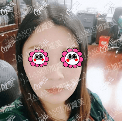 我的V美減齡面部提升術后一個月效果圖 我的V美減齡面部提升術后一個月效果圖