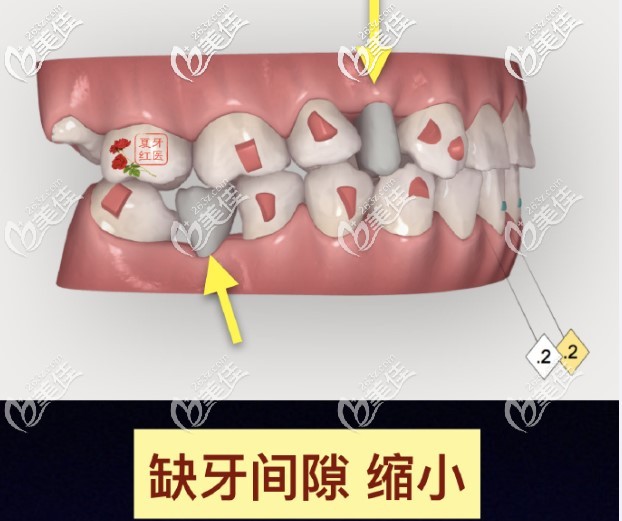 牙齒缺失太久，間隙變小怎么辦