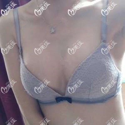 隆胸一個(gè)月摸著很不錯(cuò) 隆胸一個(gè)月摸著很不錯(cuò)