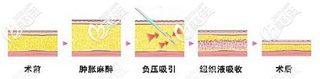 解析腰腹吸脂的原理 解析腰腹吸脂的原理