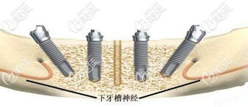 北京全口種植牙的價格