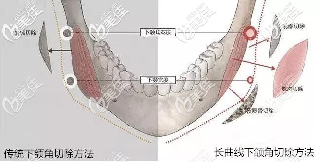 長(zhǎng)曲線下頜角跟出啊同下頜角區(qū)別 長(zhǎng)曲線下頜角跟出啊同下頜角區(qū)別