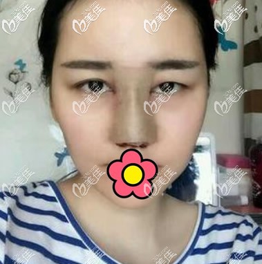 蘭州仁和做鼻子第1天