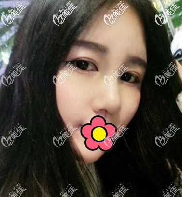 耳軟骨墊鼻尖+硅膠隆鼻一個(gè)月效果圖