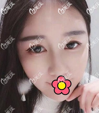 蘭州仁和<!--<i data=20240703-sp></i>-->做耳軟骨隆鼻半個(gè)月