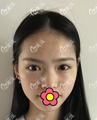 蘭州仁和整形醫(yī)院皮秒激光祛斑前 蘭州仁和整形醫(yī)院皮秒激光祛斑前