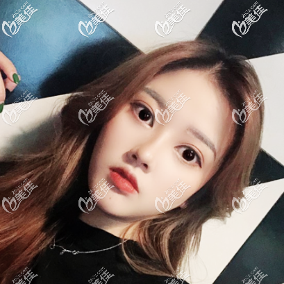 看醫(yī)療資質得知廣州廣美整形正規(guī)又可靠于是慕名去找徐立志做了雙眼皮隆鼻