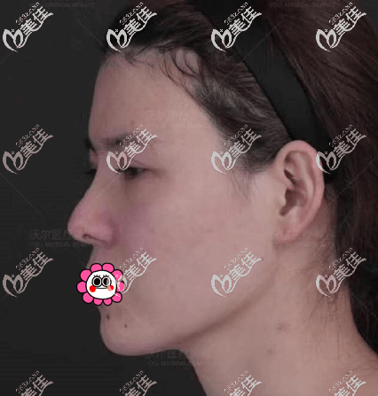 我找北京沃爾劉彥軍做鼻修復前 我找北京沃爾劉彥軍做鼻修復前