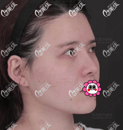 做鼻部修復前側(cè)面照 做鼻部修復前側(cè)面照