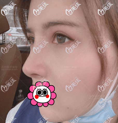 我做鼻修復后五個月<span style= 我做鼻修復后五個月<span style=