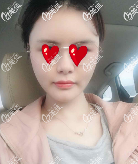 青島華顏美做面部自體脂肪填充手術第三天的樣子