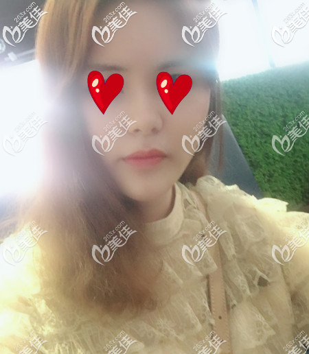 青島華顏美做面部自體脂肪填充手術第四周的樣子