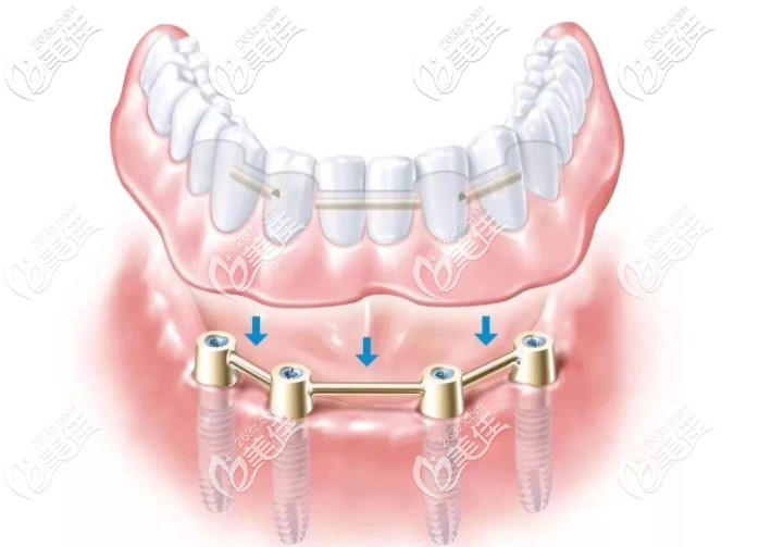 allon4種植牙圖片