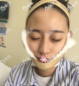 我在咖蒙醫(yī)院做完磨骨一周