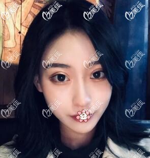 感覺國(guó)內(nèi)磨骨好的醫(yī)院價(jià)位高就去了泰國(guó)KAMOL咖蒙做了下頜角+顴骨磨骨