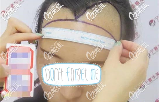 醫(yī)生在幫我設(shè)計(jì)新的發(fā)際線 醫(yī)生在幫我設(shè)計(jì)新的發(fā)際線