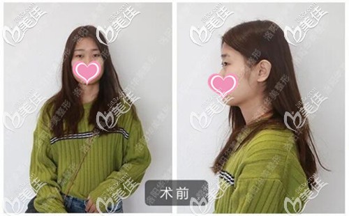 雙眼皮手術前單眼皮的樣子 雙眼皮手術前單眼皮的樣子