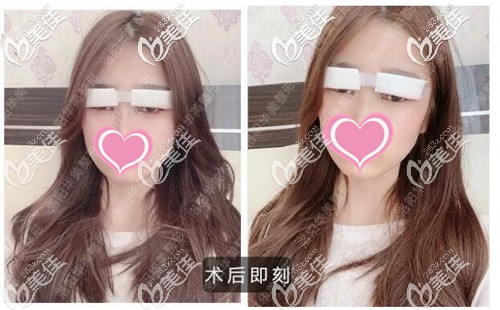 雙眼皮手術后即刻效果 雙眼皮手術后即刻效果