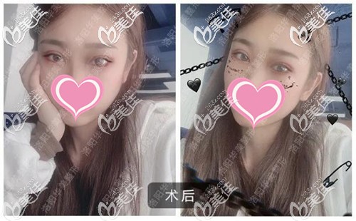 雙眼皮手術恢復一個月的效果 雙眼皮手術恢復一個月的效果