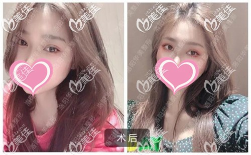 雙眼皮手術恢復三個月沒有疤痕增生 雙眼皮手術恢復三個月沒有疤痕增生