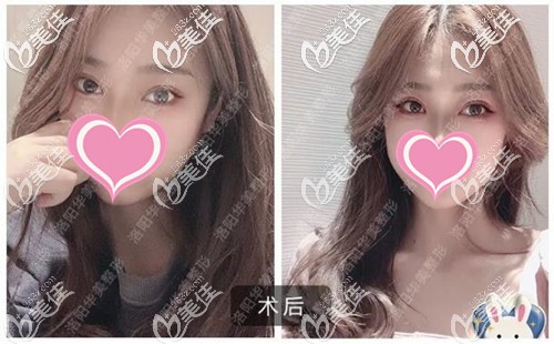 我猜在找洛陽哪個醫(yī)院割雙眼皮好的你急需這份洛陽華美整形做的全切雙眼皮案例圖