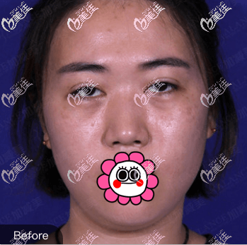 做雙眼皮修復(fù)和上瞼提肌前 做雙眼皮修復(fù)和上瞼提肌前