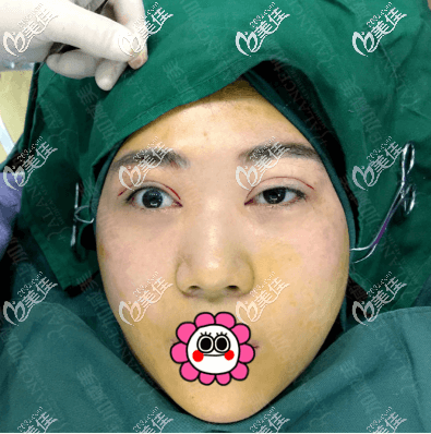 做雙眼皮修復(fù)和上瞼提肌手術(shù)當(dāng)天 做雙眼皮修復(fù)和上瞼提肌手術(shù)當(dāng)天