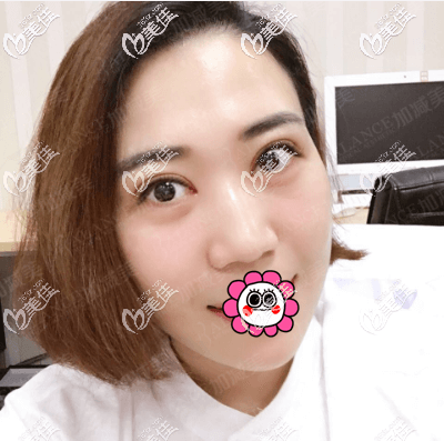 我找北京加減美潘醫(yī)生做雙眼皮修復(fù)和上瞼提肌效果自然價格不貴 我找北京加減美潘醫(yī)生做雙眼皮修復(fù)和上瞼提肌效果自然價格不貴