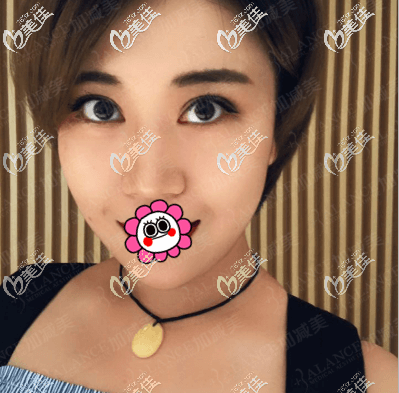 我做眼部修復(fù)和上瞼提肌二十多天了 我做眼部修復(fù)和上瞼提肌二十多天了