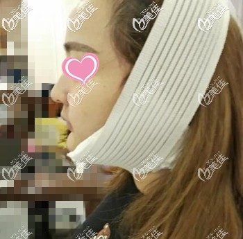 面部吸脂術(shù)后3天照