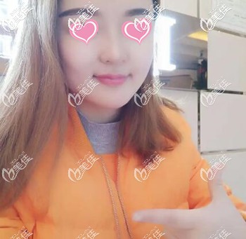 做面部吸脂術(shù)后15天效果圖