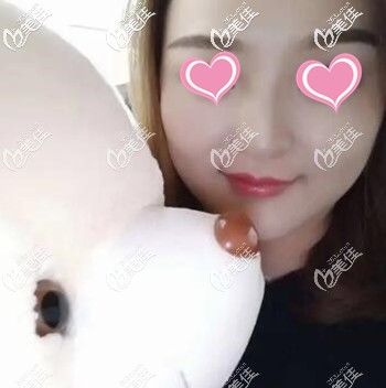 在長沙做面部吸脂術(shù)后30天效果