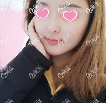 講述2個月前我在長沙做面部吸脂手術的親身經(jīng)歷及恢復效果照！