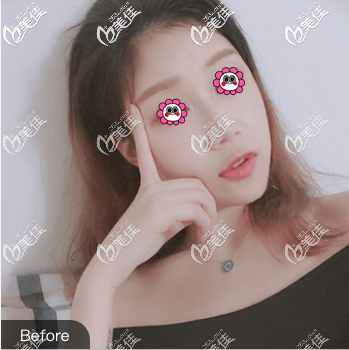 做玻尿酸豐唇前 做玻尿酸豐唇前