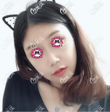 做伊碗C玻尿酸豐嘟嘟唇第五天 做伊碗C玻尿酸豐嘟嘟唇第五天