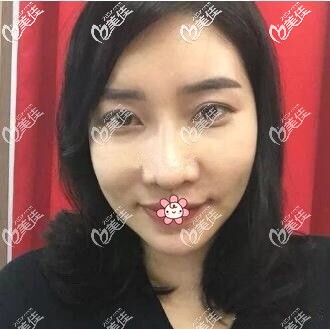 新疆黎美面部埋線提升18天 新疆黎美面部埋線提升18天