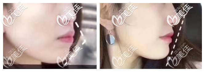 30多歲做深覆合前突矯正后下巴拉出來被誤認(rèn)為整容，無奈曬出深覆合矯正前后臉型對比變化圖