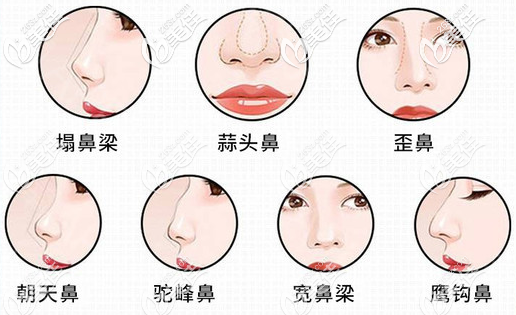 茂名華美楊群申擅長(zhǎng)改善各種不好看鼻型