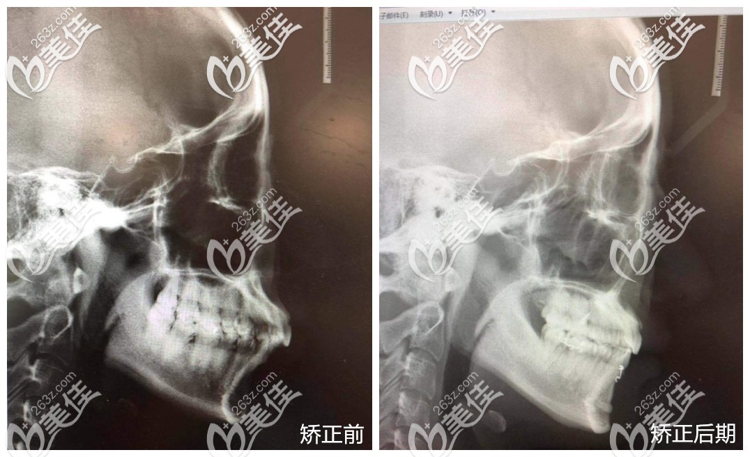 深覆頜戴牙套矯正前后嘴巴變化X片效果圖 深覆頜戴牙套矯正前后嘴巴變化X片效果圖