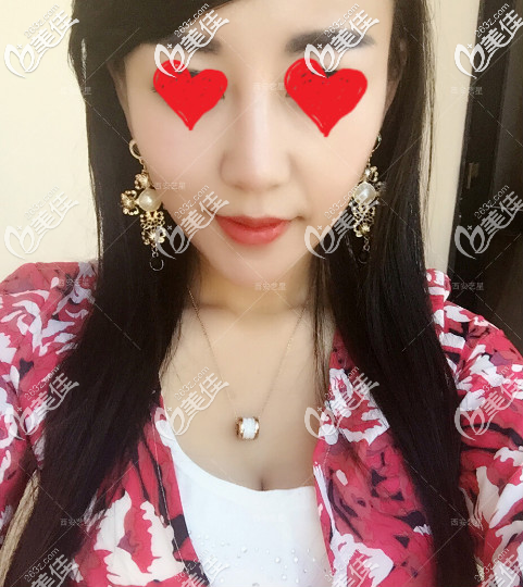 西安藝星玻尿酸豐唇術(shù)后20天 西安藝星玻尿酸豐唇術(shù)后20天