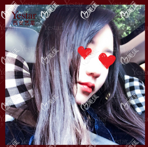 如果你問(wèn)我西安哪里做玻尿酸豐唇好，我只能用我親身的經(jīng)歷告訴你藝星不錯(cuò)