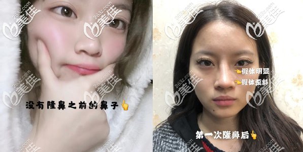 沒(méi)隆鼻前和隆鼻失敗對(duì)比照 沒(méi)隆鼻前和隆鼻失敗對(duì)比照