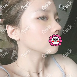 做鼻修復(fù)術(shù)后7天拆線后 做鼻修復(fù)術(shù)后7天拆線后