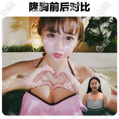 北京韓嘯棉花糖豐胸案例效果圖 北京韓嘯棉花糖豐胸案例效果圖