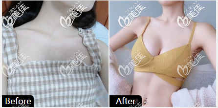 北京韓嘯給我做的棉花糖豐胸案例效果圖 北京韓嘯給我做的棉花糖豐胸案例效果圖