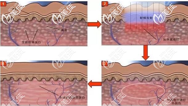 射頻緊膚的作用原理
