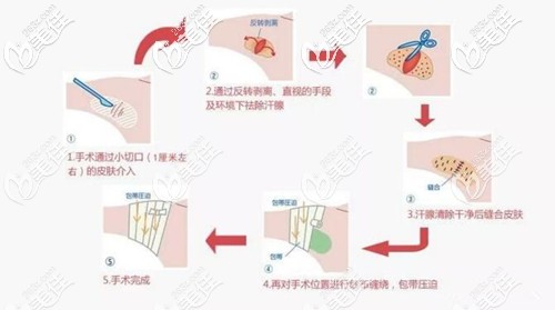 微創(chuàng)祛腋臭過(guò)程